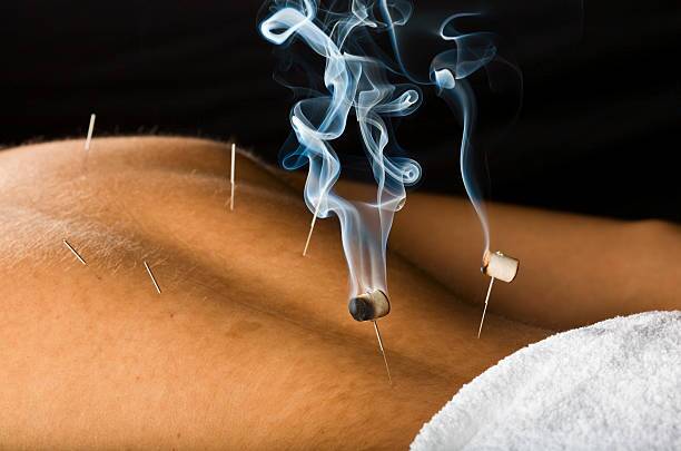 Moxibustion Moxa TCM treatment